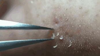 黑头闭口连根拔起,黑头粉刺连根拔起留坑