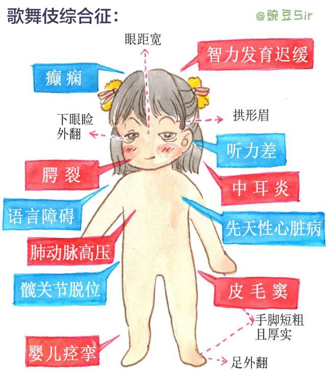 歌舞伎综合征智力正常,歌舞伎综合症都会智力低下吗