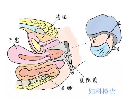 更年期出血是不是宫颈癌,妇科检查出血是宫颈癌吗