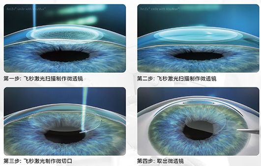 800度近视做飞秒手术还是晶体植入,800度的近视怎么治