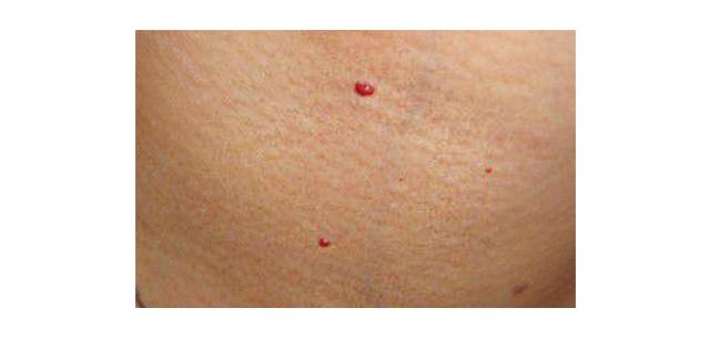 身上出现小红痣是什么原因造成的,身上出现小红痣有什么征兆