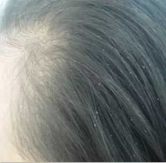 女孩头皮屑多怎么治疗,女孩头皮屑多是什么原因造成的