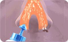 海水鼻炎喷雾,喷生理海水导致鼻炎犯了