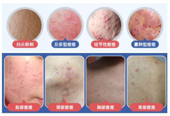 红肿，流脓的万年毒痘一喷全消失？岛国新晋痘肌终结者！彻底祛痘不反复！