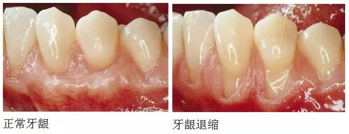 牙龈退缩怎么样刷牙,牙龈退缩牙根暴露怕冷热怎么办