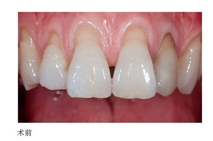 牙龈退缩怎么样刷牙,牙龈退缩牙根暴露怕冷热怎么办