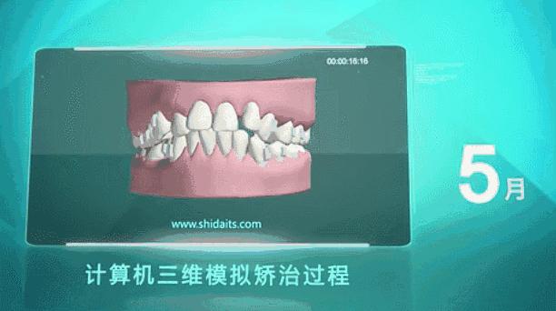 武汉种植牙齿需要多少钱,武汉种植牙齿一颗要多少钱