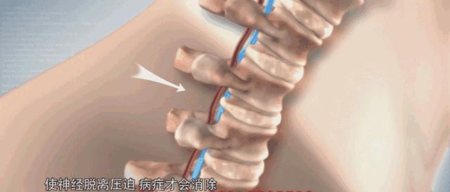 颈椎疼？脖子僵硬？睡觉用上它，颈椎病偏头痛全好了！