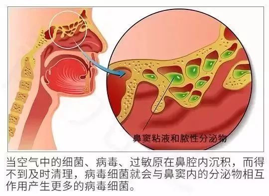 根治鼻炎只需一招,治鼻炎不复发