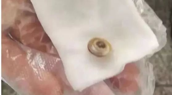 震惊！河北一岁女童鼻腔里竟取出一只蜗牛！