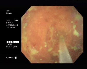治疗阑尾炎需要手术吗,阑尾炎为什么选择保守治疗呢