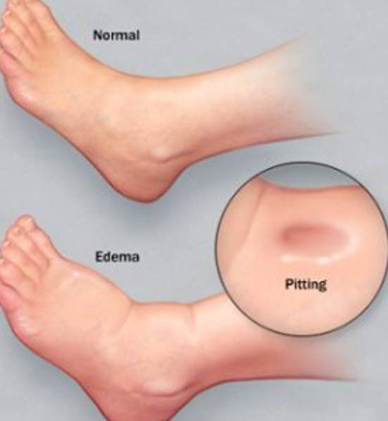 身体水肿要警惕四种肾病,身体水肿看中医什么科