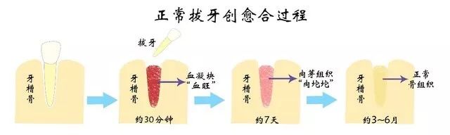 年轻人拔牙后的真实故事,拔牙疼痛的真实故事