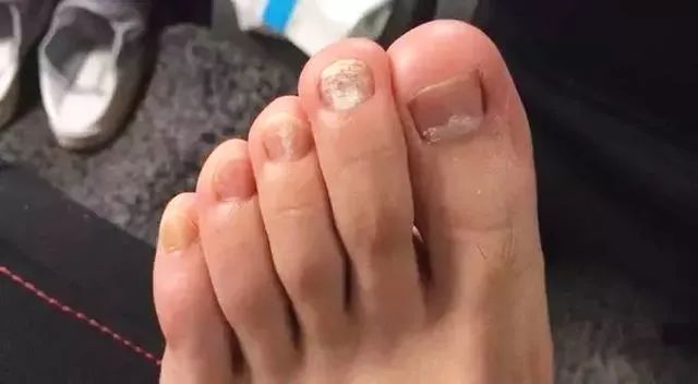 双脚有5种感觉暗示糖尿病足,双脚是报警器