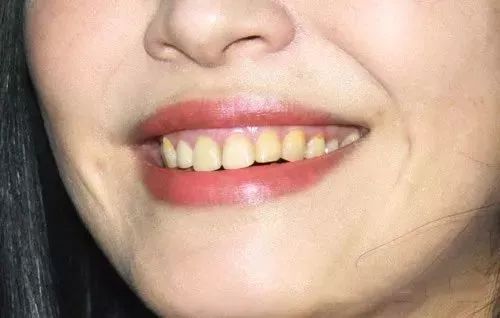 去除黄牙牙垢的牙膏,去口臭黄牙牙垢的牙膏