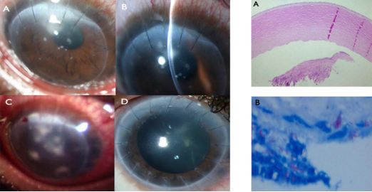孙旭光眼科医生,孙旭光大夫角膜塑形镜危害