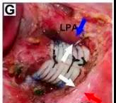 唐都医院支架手术怎么样,唐都医院支架手术