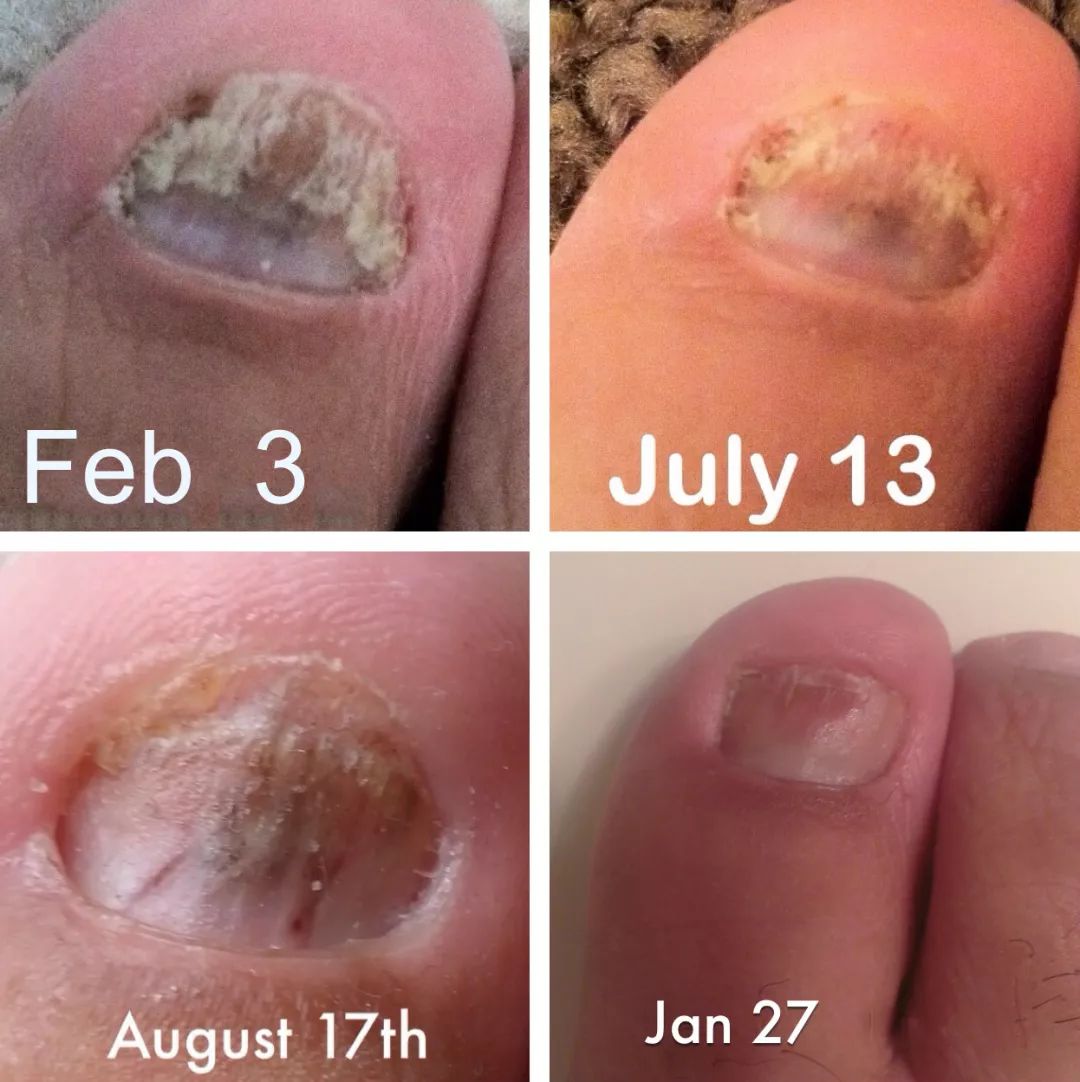 十年灰指甲可以治好吗,一次搞定顽固灰指甲