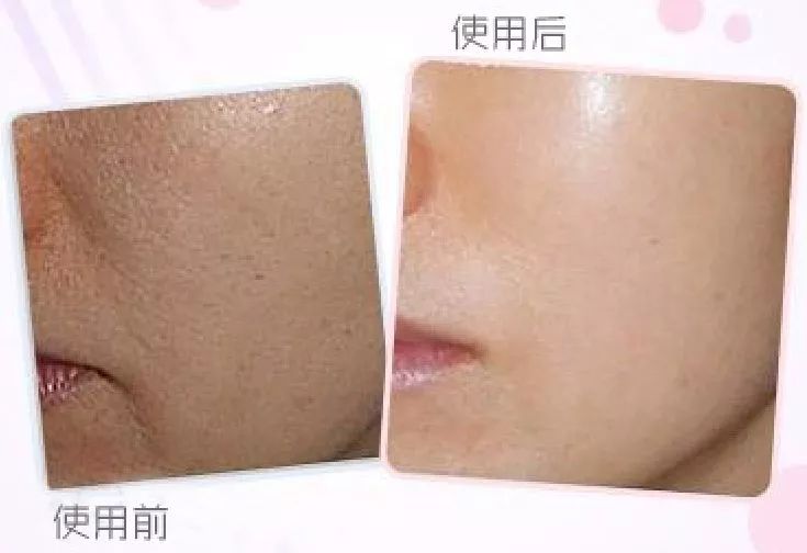 人脸上螨虫的数量,人脸上有多少螨虫