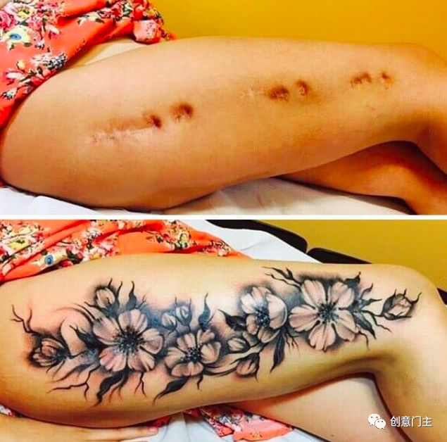 去除纹身疤痕最好的方法,疤痕纹身怎么去除