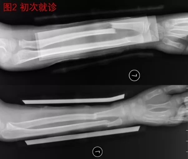 孩子胳膊骨折伸不直康复训练,小孩胳膊骨折需要做康复训练吗