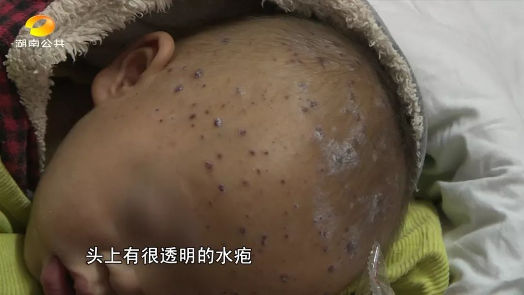 水痘患者家属如何预防,水痘患儿的护理过程及注意事项