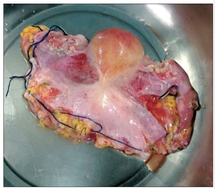 柳叶刀死而复生的病人,柳叶刀人造子宫