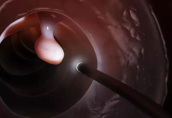 良性肠道息肉切除了还会复发吗,大肠息肉切除后还需几次复查