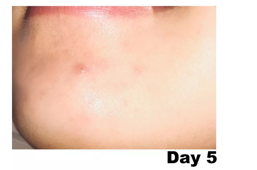 怎么对付闭口,终于找到了对抗失眠的良方