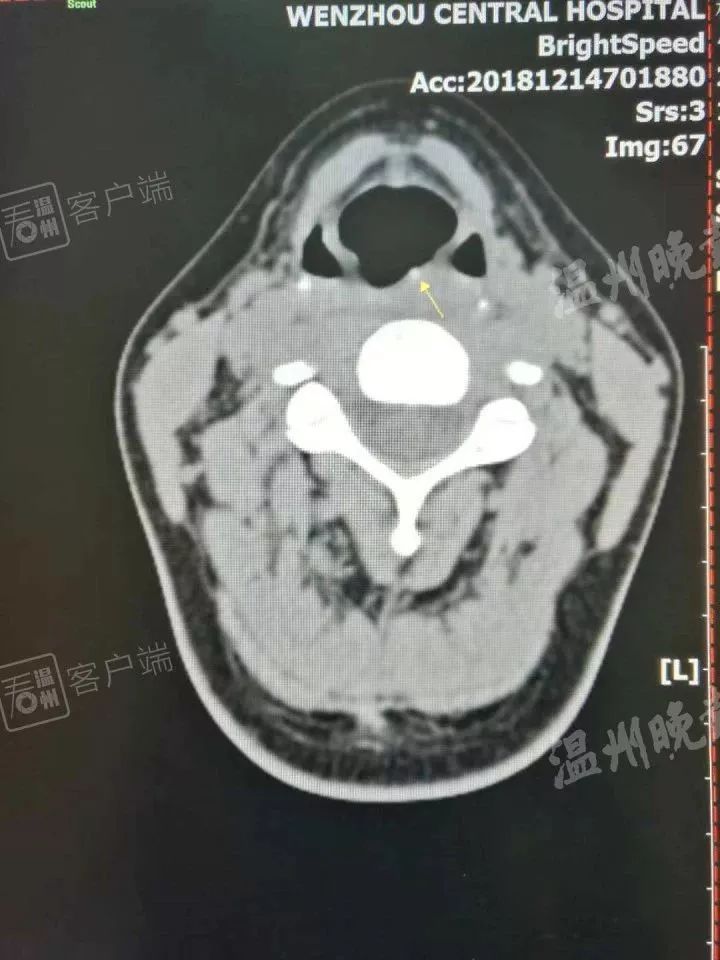 女子吃完火锅嗓子疼10分钟去医院,女子吃烧烤喉咙疼