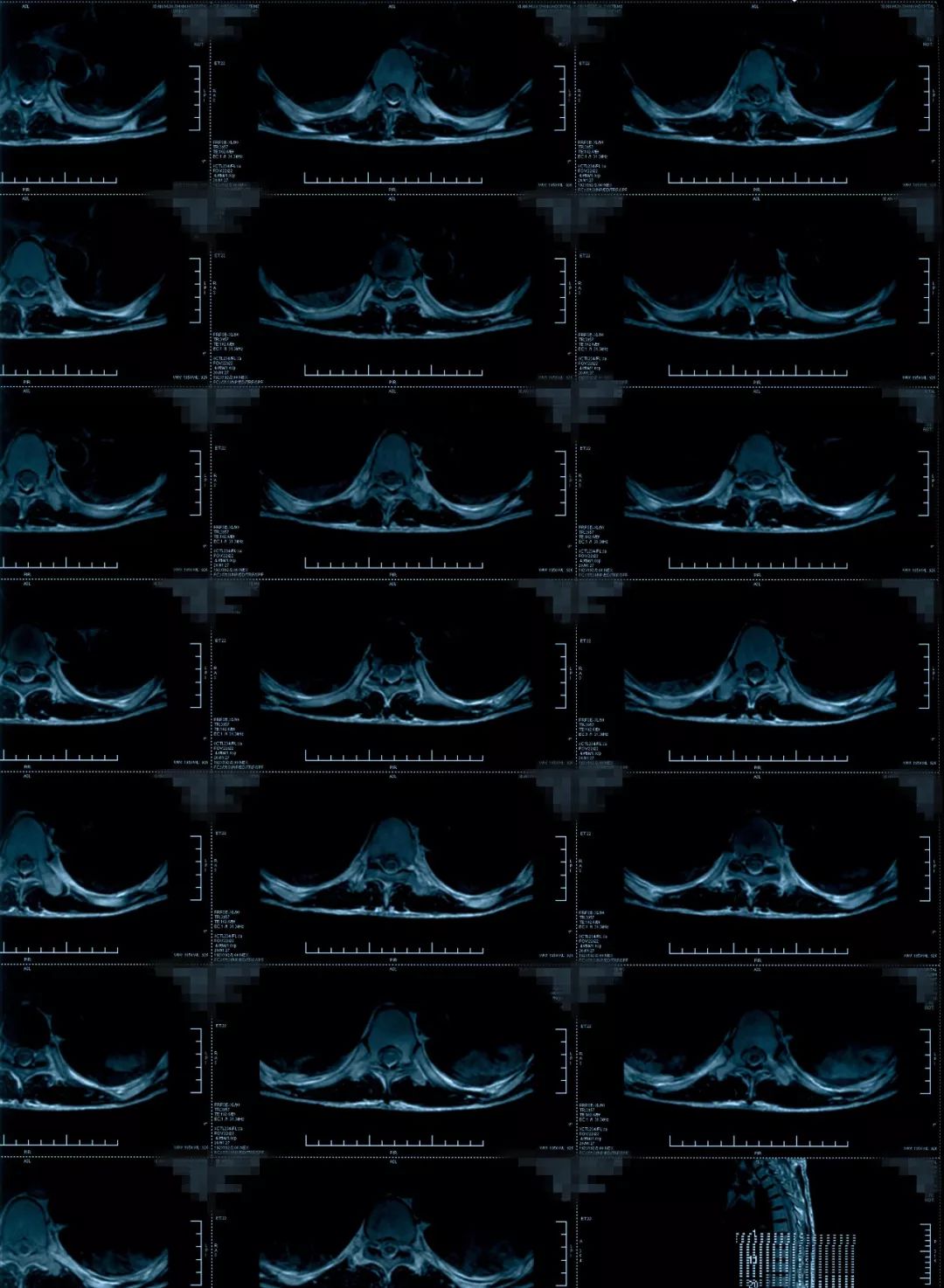椎管狭窄水肿最佳治疗方法,椎管水肿如何治疗