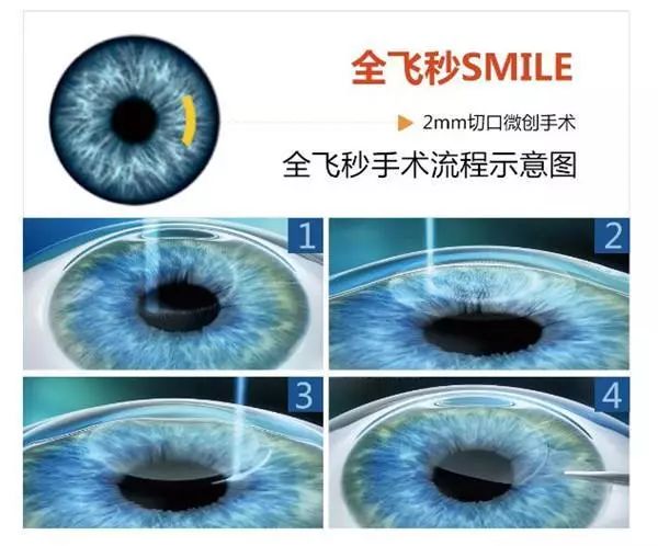 smile全飞秒手术优缺点,smile全飞秒和smart详细对比
