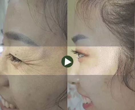 50岁没有眼袋眼纹黑眼圈,60岁去眼袋的最佳方法