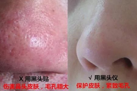 辣眼睛，有人用它吸出一整年的黑头，看完我果断下单了！