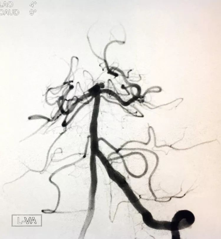 柳暗花明专栏|栓塞颅内动脉瘤时微导管无法穿过LVIS支架网眼怎么办