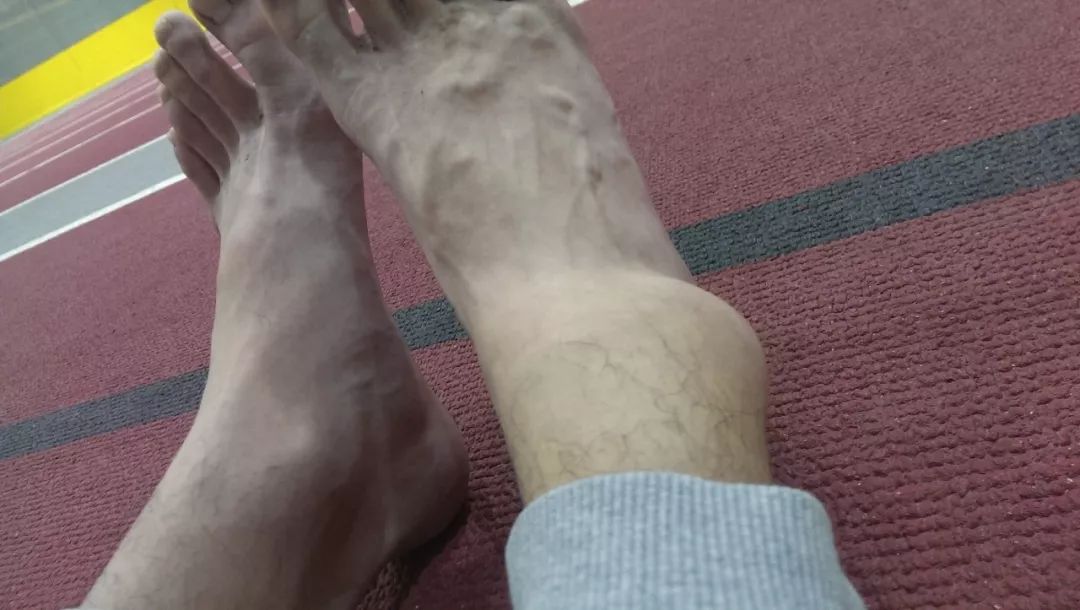 俄罗斯留学生骨折截肢,留学生意外被截肢