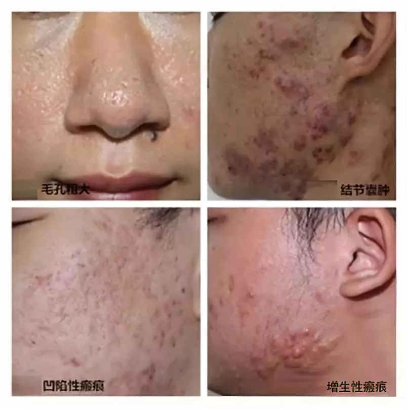 祛痘药膏活动,祛痘医疗活动方案