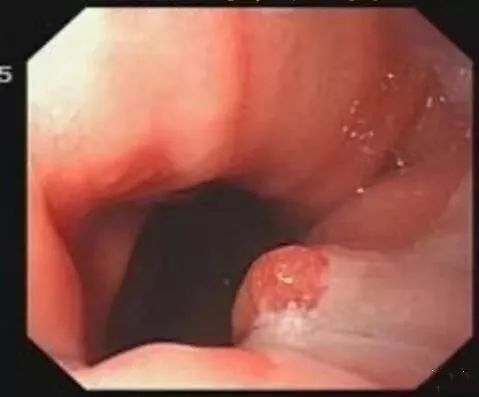 一文盘点|临床上常见的息肉病