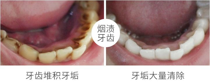 牙黄口臭三分钟见效,牙黄口臭去烟渍