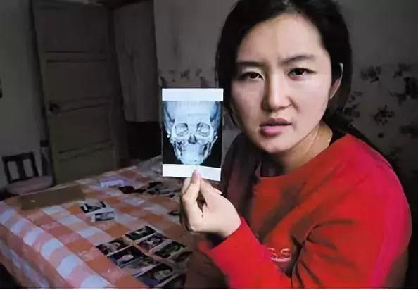 整容315事件真实案例,整容毁容真实案例如何赔偿