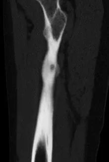 「安心过年」微创手术直击病灶！两骨瘤患者慕名而来，携健康回家