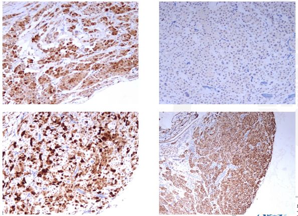 50岁女性胸腔积液是怎么形成的呢,26岁胸腔积液引起原因