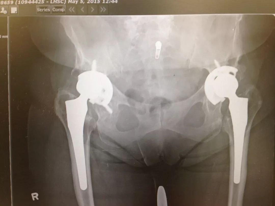 「筋骨堂」人工髋关节并非一劳永逸