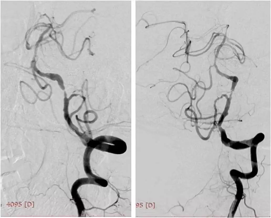 椎动脉v4段血管瘤介入治疗,臭氧治疗左侧v4段椎动脉狭窄