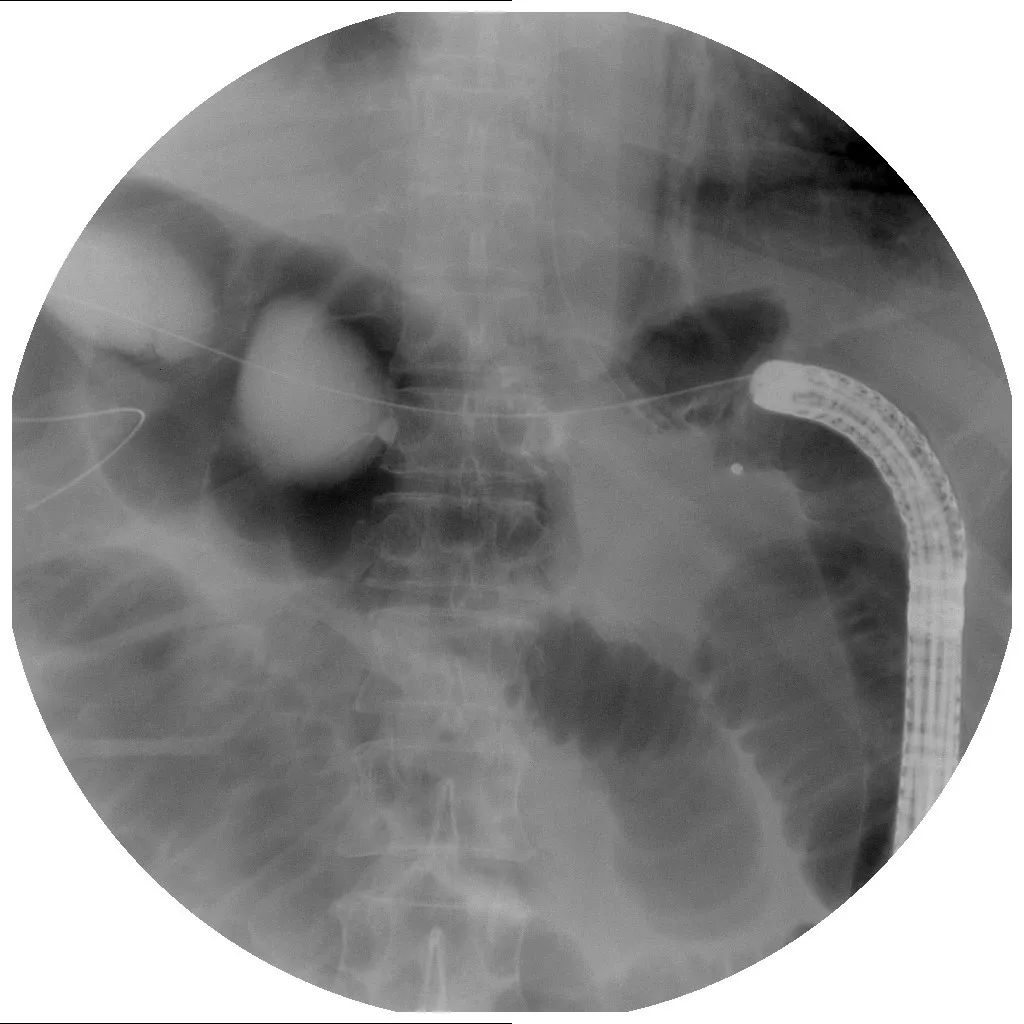 消化道支架置入术,消化道梗阻支架怎么放