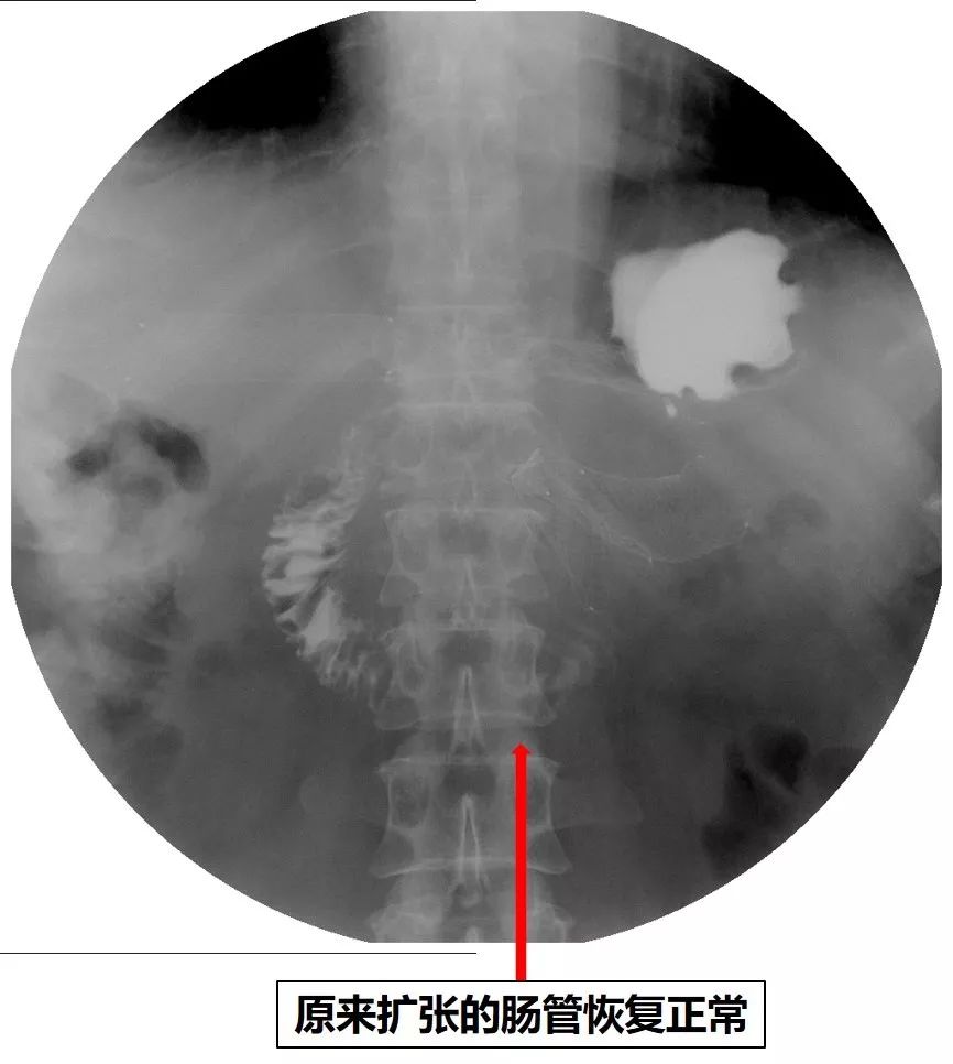 消化道支架置入术,消化道梗阻支架怎么放