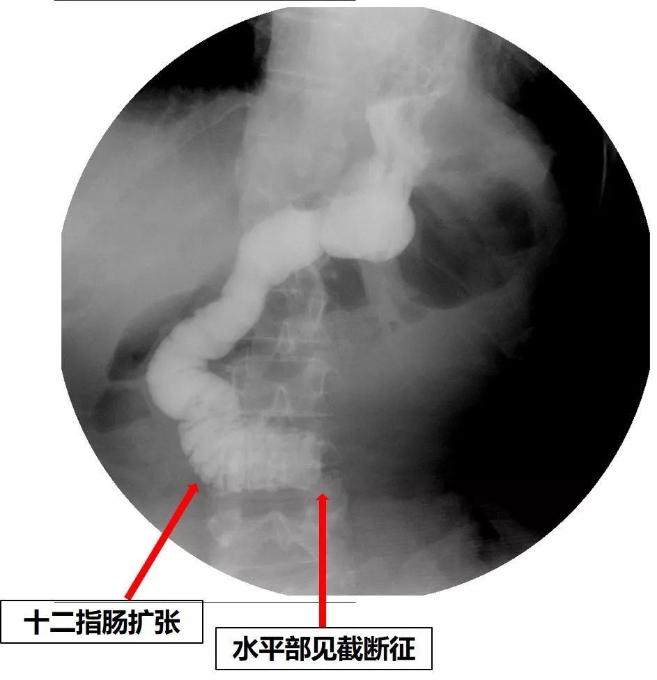 消化道支架置入术,消化道梗阻支架怎么放