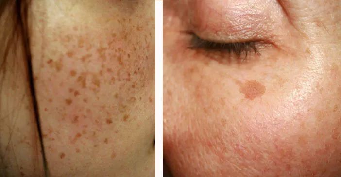 严重痘印晒斑,5个祛斑小妙招淡化晒斑雀斑痘印