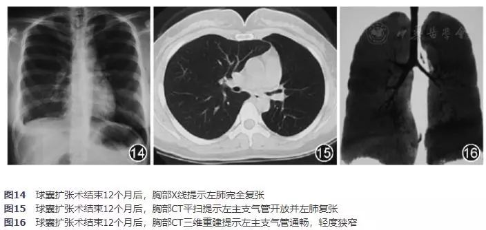 球囊扩张治疗狭窄,支气管结核冷冻术