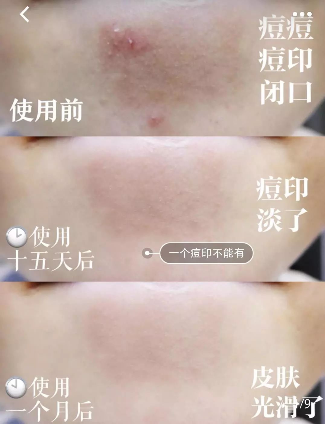 疤痕体质如何去痘印和烫伤印,烫伤色素疤痕修复的最新方法